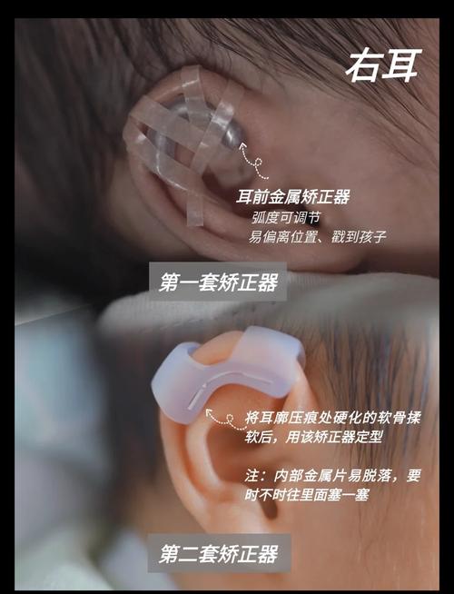 新生儿耳轮粘连该矫正吗？-第3张图片-中州医学会