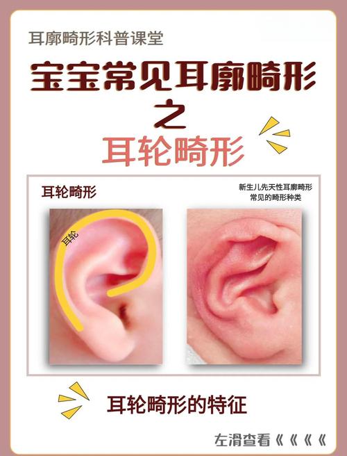 新生儿耳轮粘连该矫正吗？-第1张图片-中州医学会