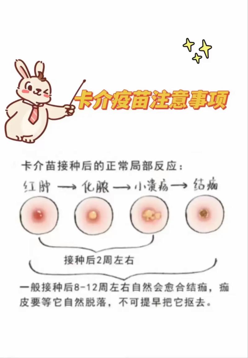 新生儿卡介苗化脓破了咋处理？-第2张图片-中州医学会