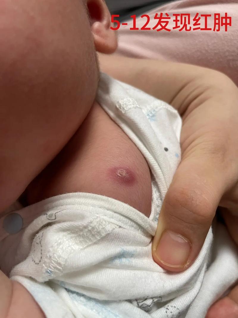 新生儿卡介苗化脓破了咋处理？-第3张图片-中州医学会