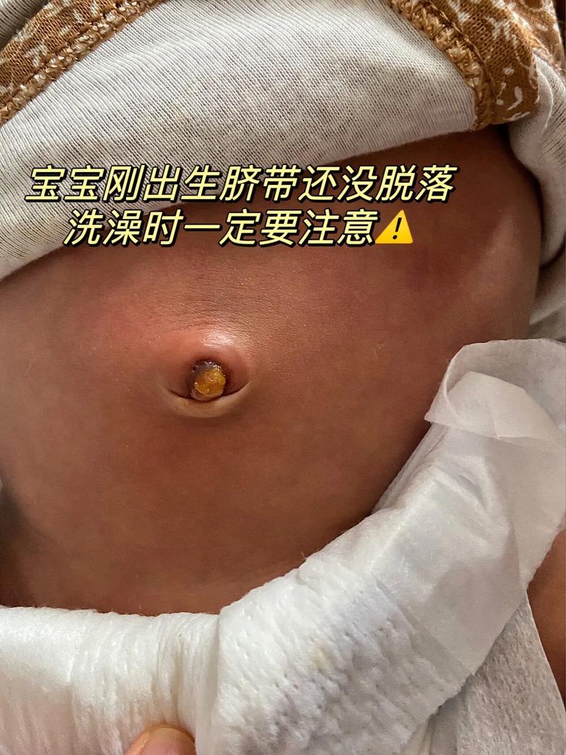 脐带脱落前能洗澡吗？-第3张图片-中州医学会