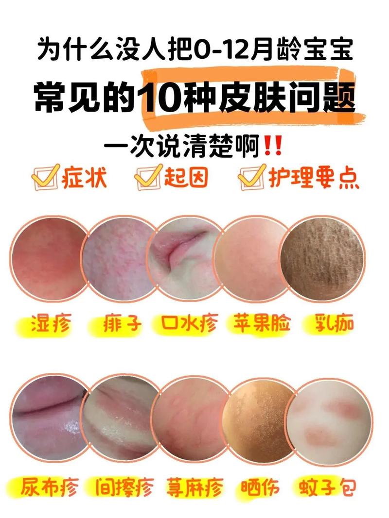 新生儿湿疹和痤疮图片如何区分？-第2张图片-中州医学会