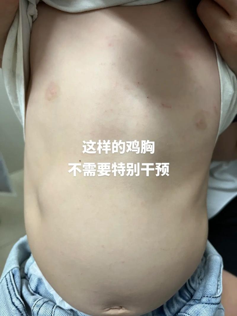 儿童气胸有哪些症状体征表现？-第2张图片-中州医学会