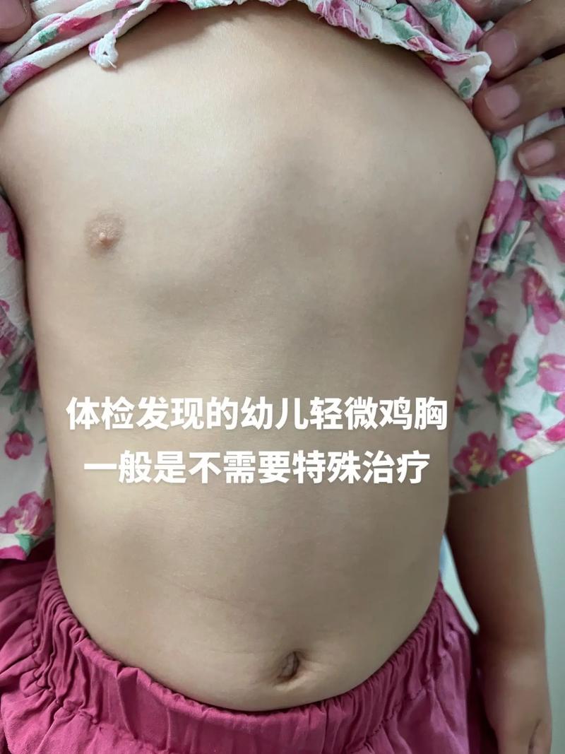 儿童气胸有哪些症状体征表现？-第1张图片-中州医学会