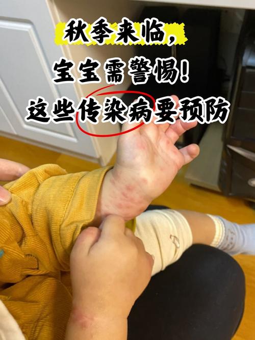 儿童免疫缺陷病有哪些症状？-第3张图片-中州医学会