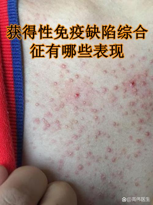 儿童免疫缺陷病有哪些症状？-第1张图片-中州医学会