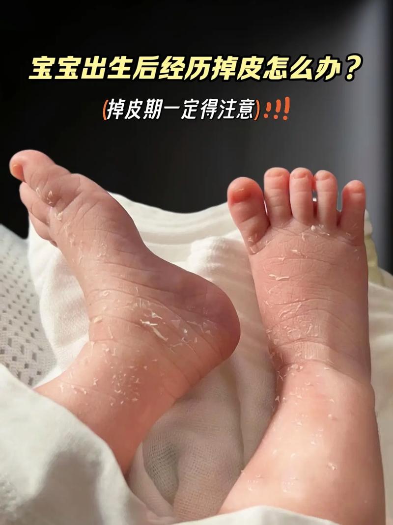 新生儿手脚脱皮需要抹东西吗-第3张图片-中州医学会