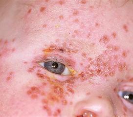 儿童支原体衣原体感染有哪些典型症状？-第2张图片-中州医学会