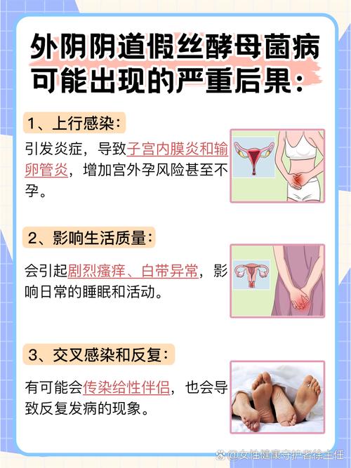 孕期霉菌性阴炎怎么治疗才安全？-第3张图片-中州医学会