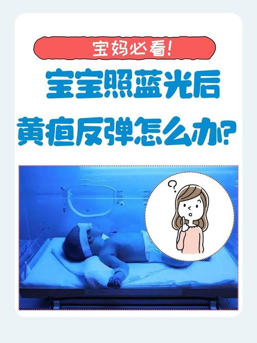新生儿黄疸蓝光治疗几天能好？-第2张图片-中州医学会