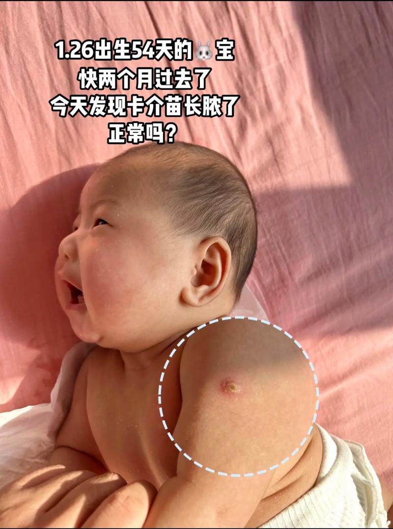 新生儿打卡介苗后有哪些常见反应？-第1张图片-中州医学会