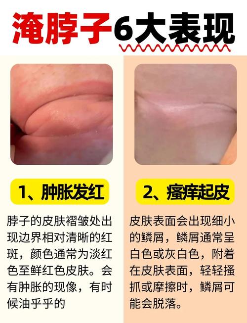 新生儿脖子淹破皮，如何正确护理处理？-第1张图片-中州医学会