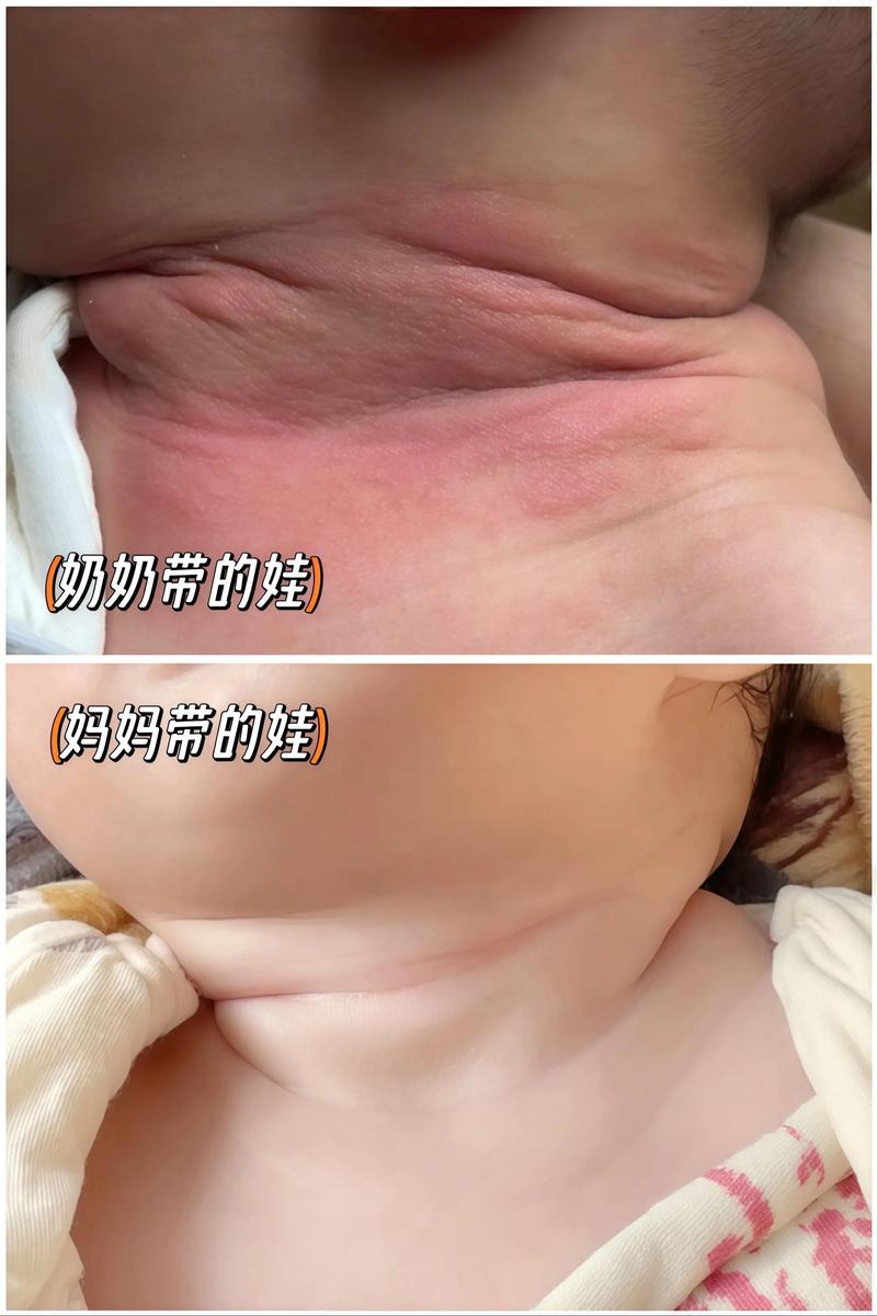 新生儿脖子淹破皮，如何正确护理处理？-第3张图片-中州医学会