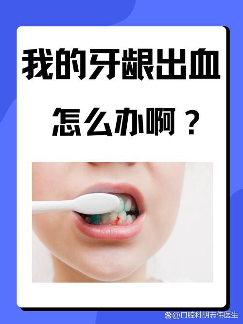 孕期牙龈出血咋办？-第3张图片-中州医学会