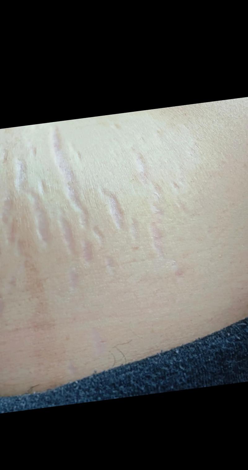 孕期如何不长妊娠纹？-第1张图片-中州医学会