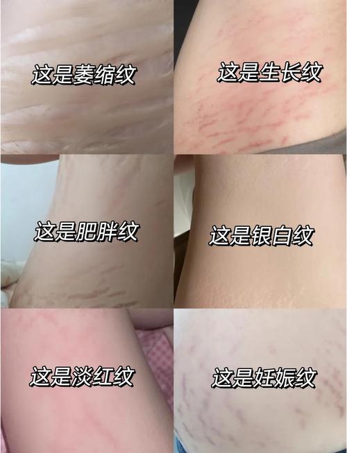 孕期如何不长妊娠纹？-第2张图片-中州医学会