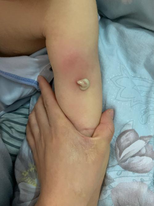 新生儿硬肿症硬肿最初出现在哪里？-第1张图片-中州医学会