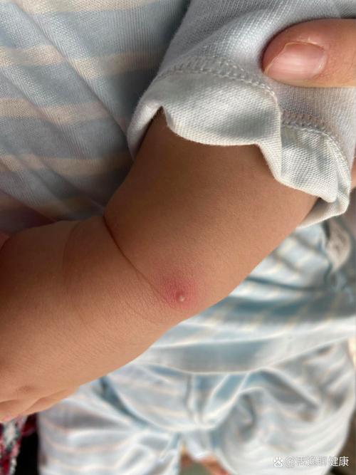 新生儿硬肿症硬肿最初出现在哪里？-第2张图片-中州医学会
