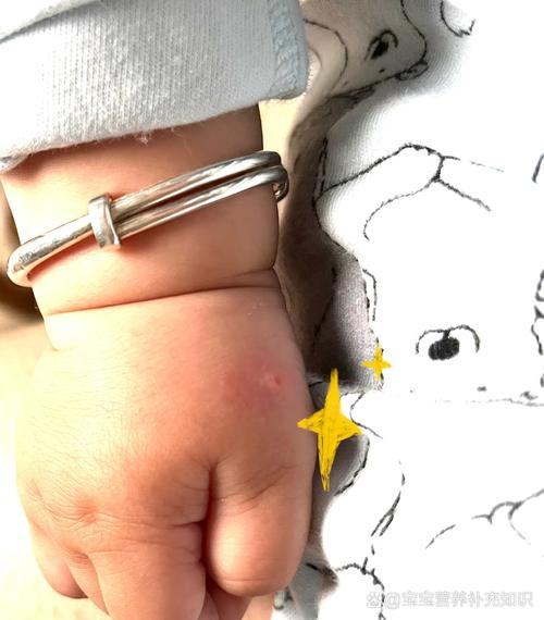 新生儿硬肿症硬肿最初出现在哪里？-第3张图片-中州医学会