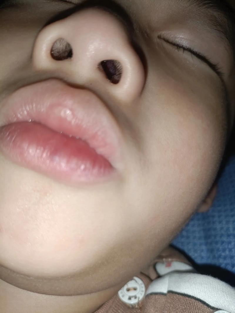 儿童鼻内肉红肿堵塞怎么办？-第3张图片-中州医学会