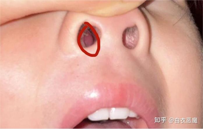 儿童鼻内肉红肿堵塞怎么办？-第2张图片-中州医学会