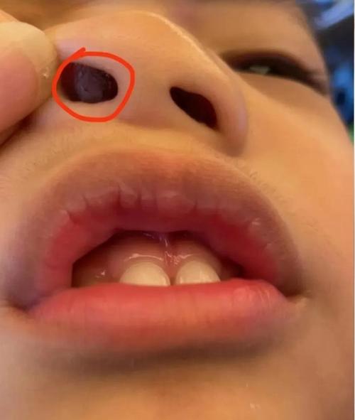 儿童鼻内肉红肿堵塞怎么办？-第1张图片-中州医学会