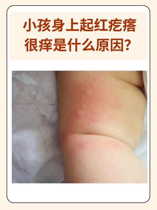 儿童皮肤干燥瘙痒是何原因导致？-第2张图片-中州医学会