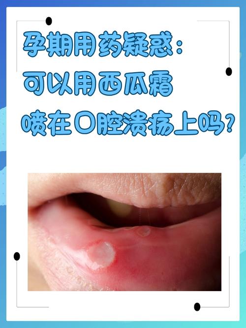 备孕期间可以喷西瓜霜吗-第1张图片-中州医学会