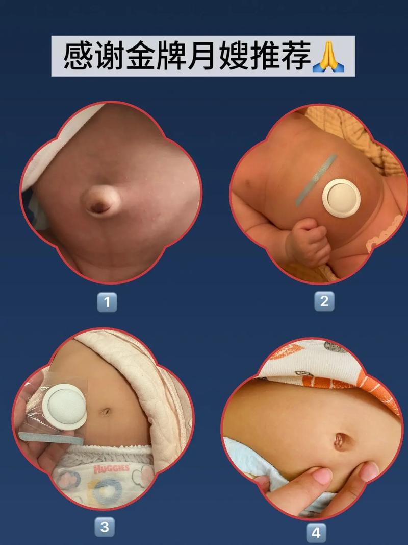 新生儿肚脐鼓出来是怎么回事-第1张图片-中州医学会