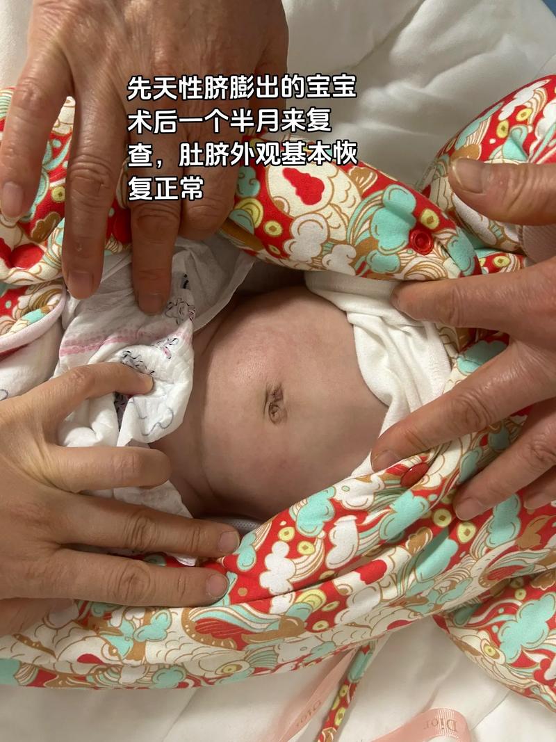 新生儿肚脐鼓出来是怎么回事-第3张图片-中州医学会