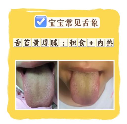 儿童舌苔厚黄最快处理办法是什么？-第2张图片-中州医学会