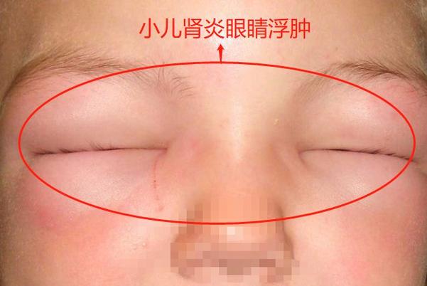 儿童肾炎早期症状有哪些？-第3张图片-中州医学会