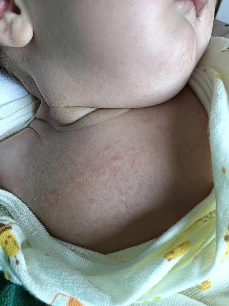 新生儿打乙肝疫苗会有哪些反应？-第1张图片-中州医学会