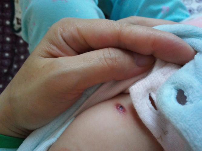 新生儿打乙肝疫苗会有哪些反应？-第3张图片-中州医学会