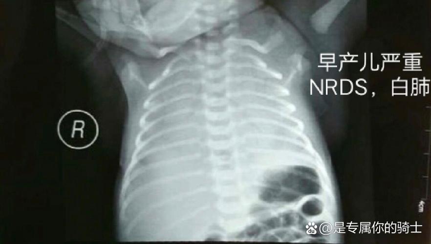 新生儿照X光会影响健康吗？-第1张图片-中州医学会