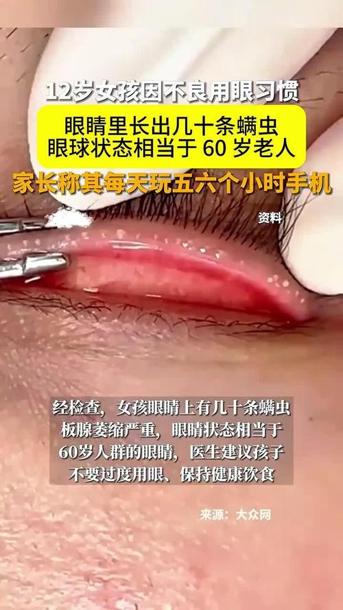 儿童玩手机，眼睛危害究竟有多严重？-第3张图片-中州医学会