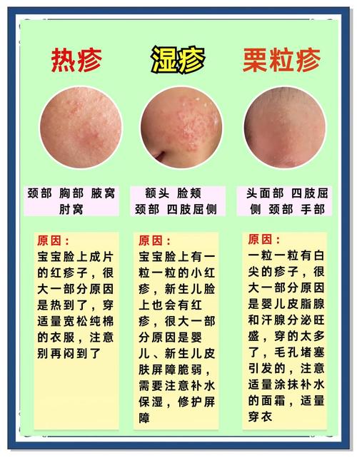 新生儿湿疹和痱子图片如何区分？-第1张图片-中州医学会