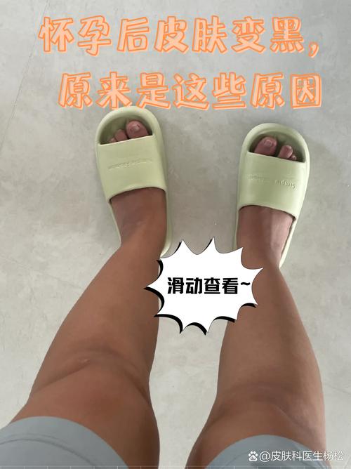 孕期皮肤变黑，怎么有效改善？-第3张图片-中州医学会