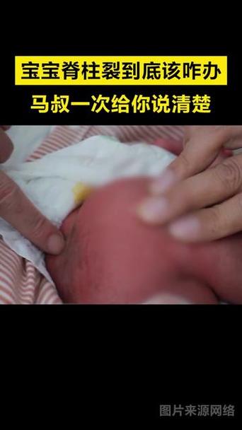 儿童隐形脊柱裂有哪些典型症状?-第2张图片-中州医学会 儿童隐形脊柱裂有哪些典型症状?-第2张图片-中州医学会