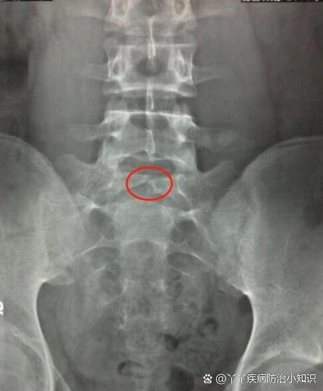 儿童隐形脊柱裂有哪些典型症状?-第3张图片-中州医学会 儿童隐形脊柱裂有哪些典型症状?-第3张图片-中州医学会