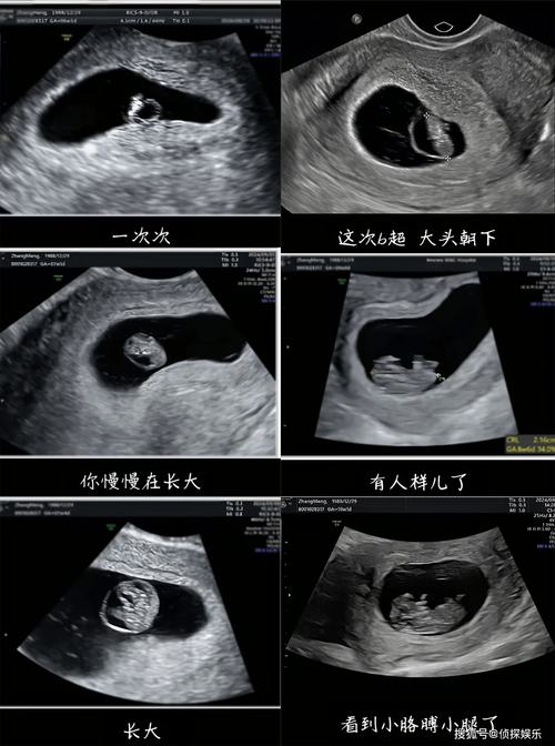 孕期十几次B超,真的有必要吗?-第1张图片-中州医学会 孕期十几次B超,真的有必要吗?-第1张图片-中州医学会