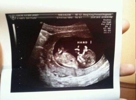 孕期十几次B超，真的有必要吗？-第3张图片-中州医学会