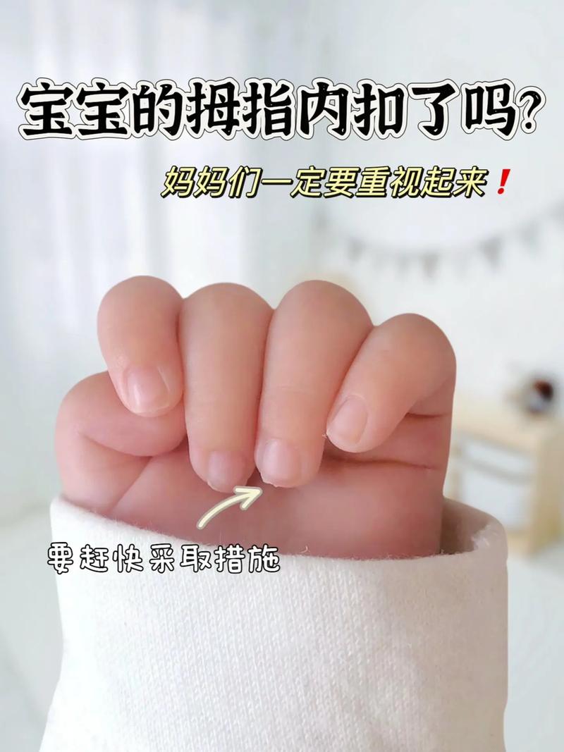 新生儿握拳大拇指内扣正常吗-第1张图片-中州医学会 新生儿握拳大拇指内扣正常吗-第1张图片-中州医学会