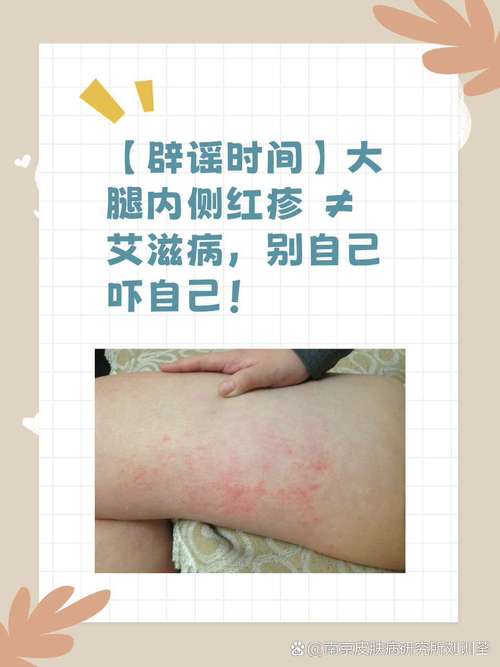 儿童大腿内侧大片红疹是何原因?-第3张图片-中州医学会 儿童大腿内侧大片红疹是何原因?-第3张图片-中州医学会