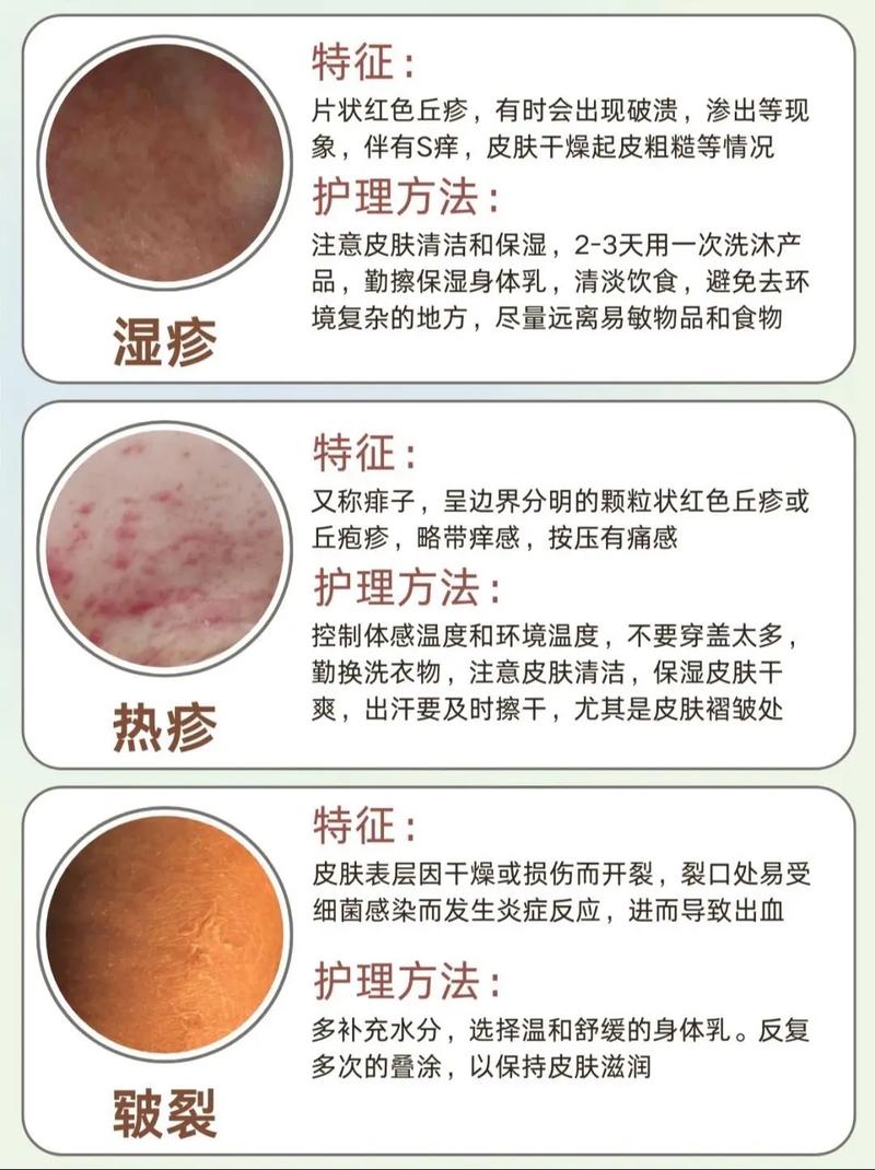 新生儿脸湿疹,最佳疗法是啥?-第2张图片-中州医学会 新生儿脸湿疹,最佳疗法是啥?-第2张图片-中州医学会
