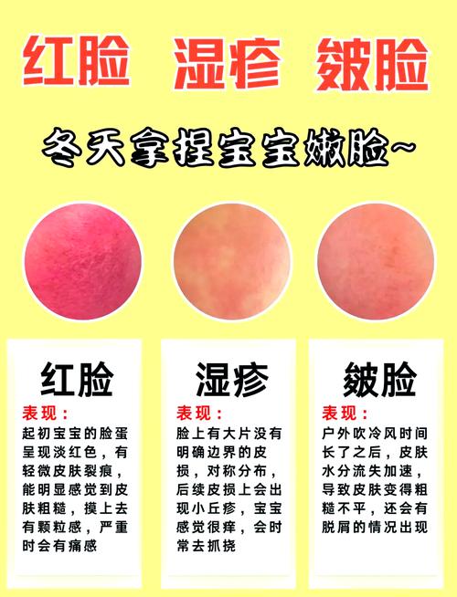 新生儿脸湿疹,最佳疗法是啥?-第1张图片-中州医学会 新生儿脸湿疹,最佳疗法是啥?-第1张图片-中州医学会