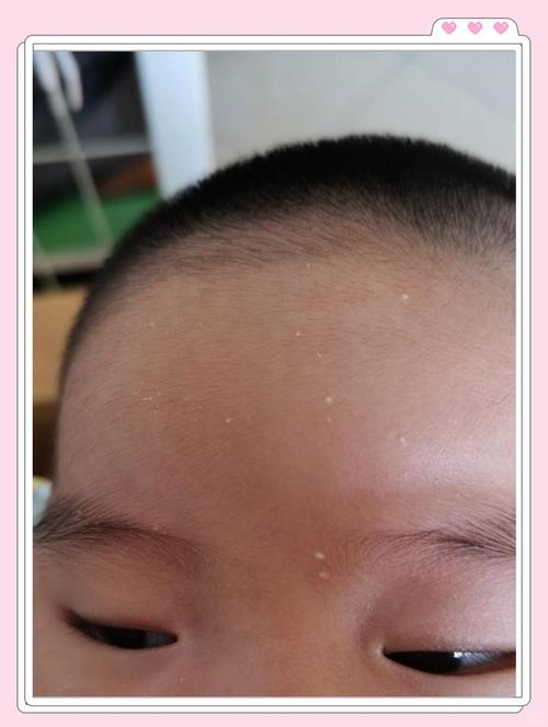 新生儿脸上小白点多久能自行消退?-第2张图片-郑州医学网 新生儿脸上小白点多久能自行消退?-第2张图片-郑州医学网