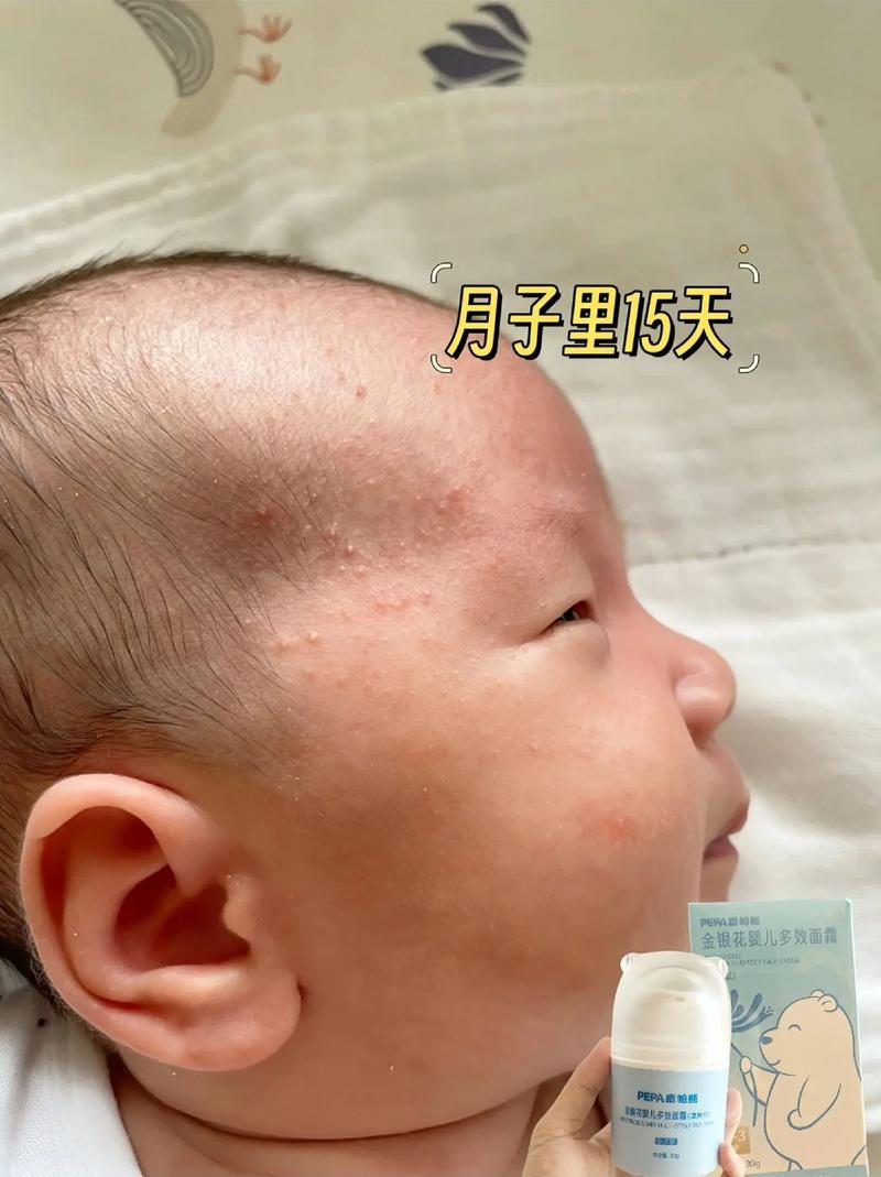 新生儿脸上小白点多久能自行消退?-第1张图片-郑州医学网 新生儿脸上小白点多久能自行消退?-第1张图片-郑州医学网