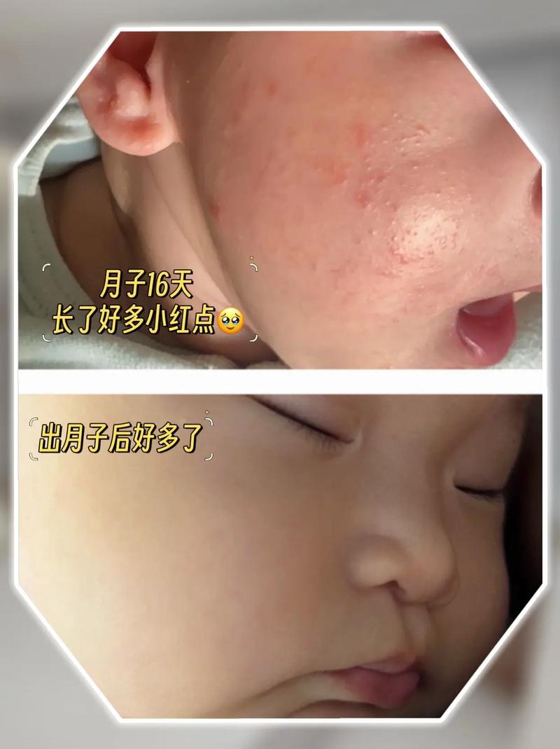 新生儿脸上小白点多久能自行消退?-第3张图片-郑州医学网 新生儿脸上小白点多久能自行消退?-第3张图片-郑州医学网