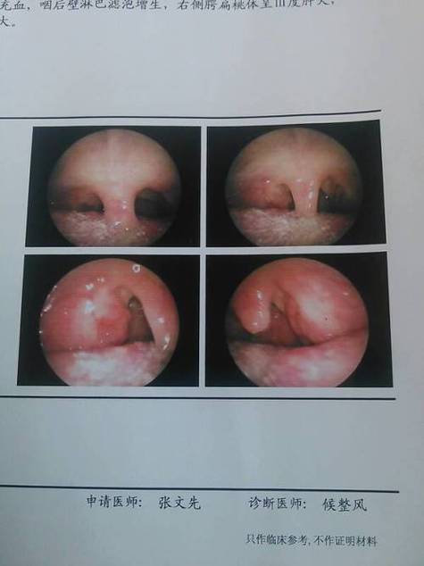 儿童咽后壁淋巴滤泡增生怎么办？-第3张图片-郑州医学网